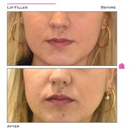FILLER - Lip - Before and After