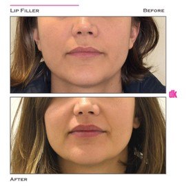 FILLER - Lip - Before and After