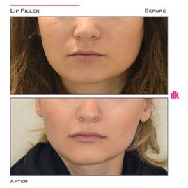 FILLER - Lip - Before and After