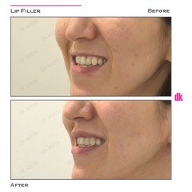 FILLER - Lip - Before and After
