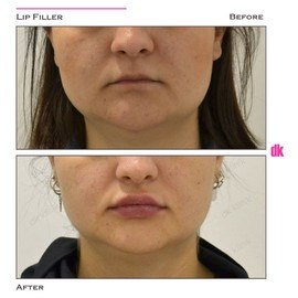 FILLER - Lip - Before and After