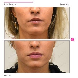 FILLER - Lip - Before and After