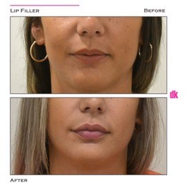 FILLER - Lip - Before and After