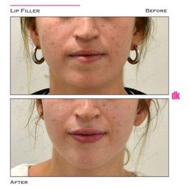 FILLER - Lip - Before and After