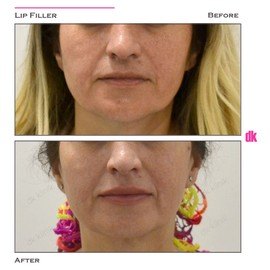 FILLER - Lip - Before and After