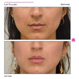 FILLER - Lip - Before and After