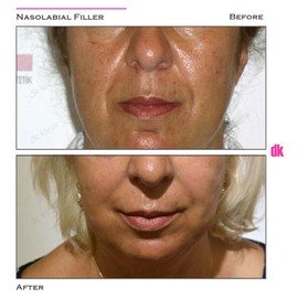 FILLER- Nasolabial Fold - Before and After