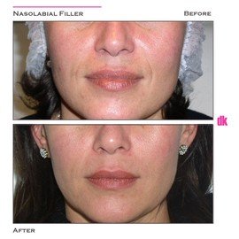FILLER- Nasolabial Fold - Before and After
