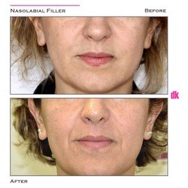 FILLER- Nasolabial Fold - Before and After