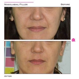 FILLER- Nasolabial Fold - Before and After