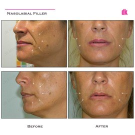 FILLER- Nasolabial Fold - Before and After