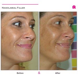 FILLER- Nasolabial Fold - Before and After