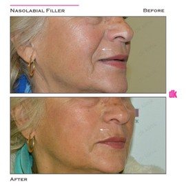 FILLER- Nasolabial Fold - Before and After