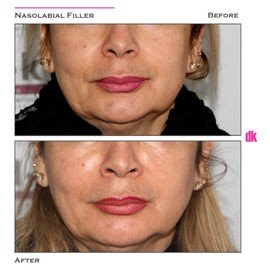 FILLER- Nasolabial Fold - Before and After