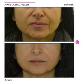FILLER- Nasolabial Fold - Before and After