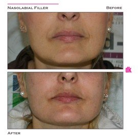 FILLER- Nasolabial Fold - Before and After