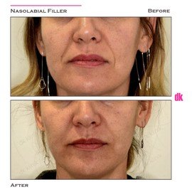 FILLER- Nasolabial Fold - Before and After