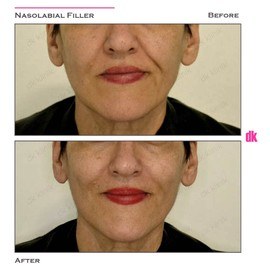 FILLER- Nasolabial Fold - Before and After