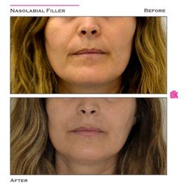 FILLER- Nasolabial Fold - Before and After