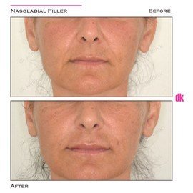 FILLER- Nasolabial Fold - Before and After