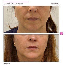 FILLER- Nasolabial Fold - Before and After