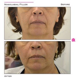 FILLER- Nasolabial Fold - Before and After