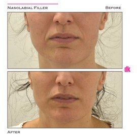 FILLER- Nasolabial Fold - Before and After