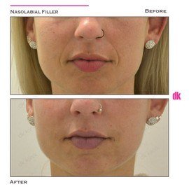 FILLER- Nasolabial Fold - Before and After