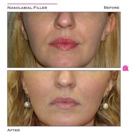 FILLER- Nasolabial Fold - Before and After