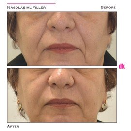 FILLER- Nasolabial Fold - Before and After
