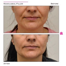 FILLER- Nasolabial Fold - Before and After
