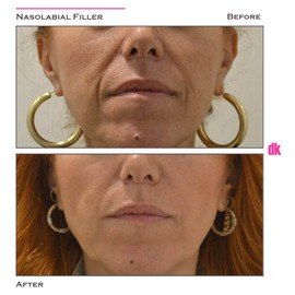 FILLER- Nasolabial Fold - Before and After