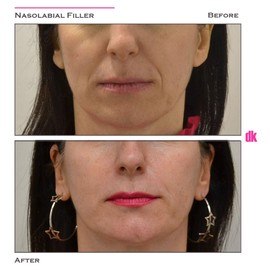 FILLER- Nasolabial Fold - Before and After