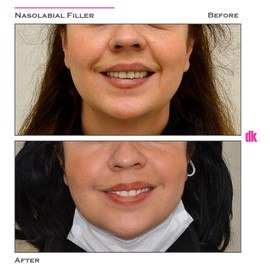 FILLER- Nasolabial Fold - Before and After
