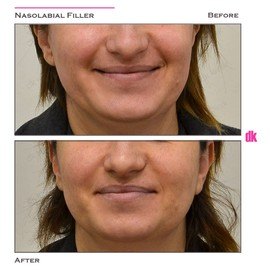 FILLER- Nasolabial Fold - Before and After