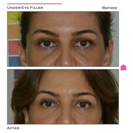 FILLER - Under - Eye - Before and After