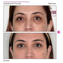FILLER - Under - Eye - Before and After