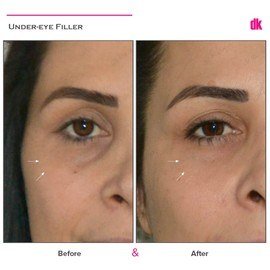 FILLER - Under - Eye - Before and After