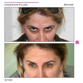FILLER - Under - Eye - Before and After
