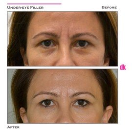 FILLER - Under - Eye - Before and After