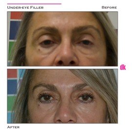 FILLER - Under - Eye - Before and After