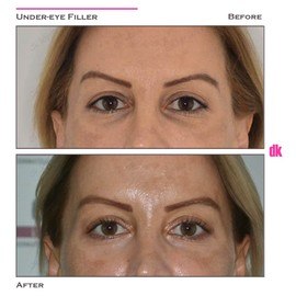FILLER - Under - Eye - Before and After
