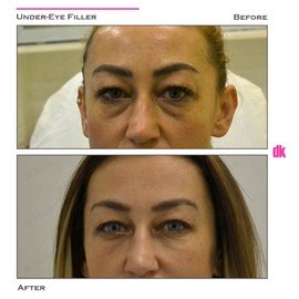 FILLER - Under - Eye - Before and After