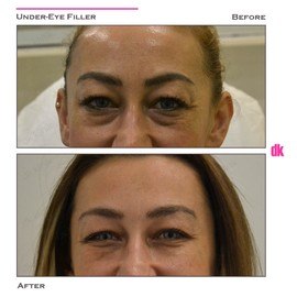 FILLER - Under - Eye - Before and After