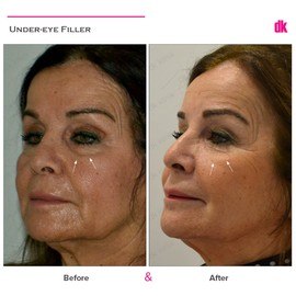 FILLER - Under - Eye - Before and After