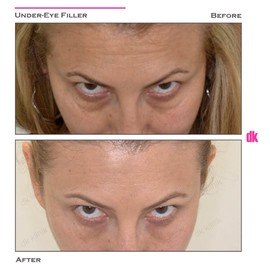 FILLER - Under - Eye - Before and After