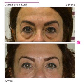 FILLER - Under - Eye - Before and After