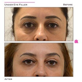 FILLER - Under - Eye - Before and After