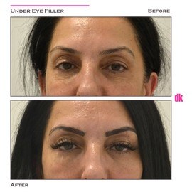 FILLER - Under - Eye - Before and After