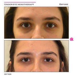 FILLER - Under - Eye - Before and After